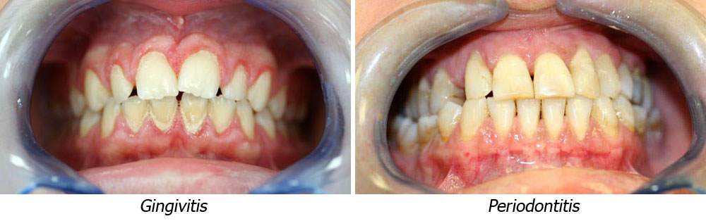 Enfermedades periodontales