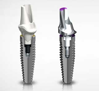 Implantes dentales Nobel Biocare