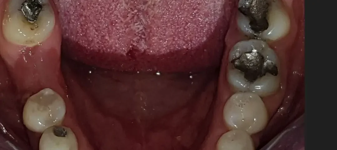Amalgamas antiguas de plata