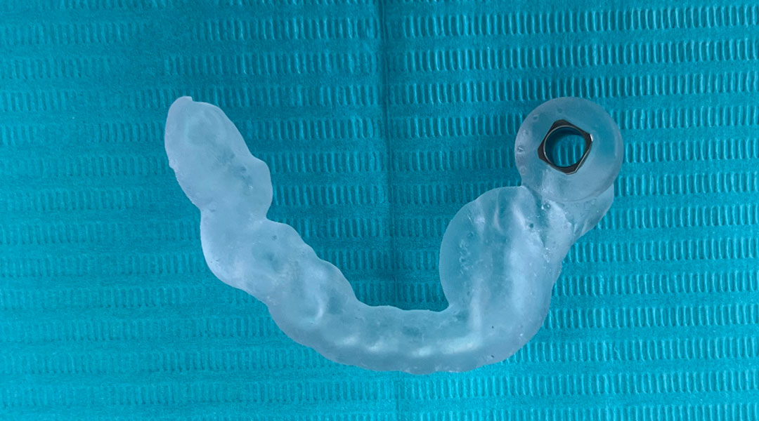 Férula guiada digital para implante en Clinica Fuset