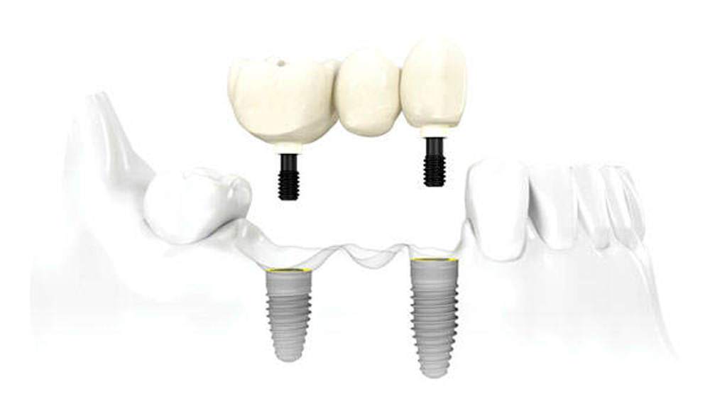 Implantes dentales en Clinica Dr. Fuset